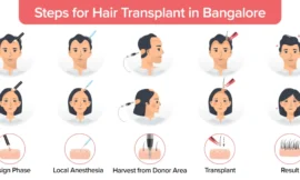 Hair Transplant In Bangalore: The Ultimate Guide